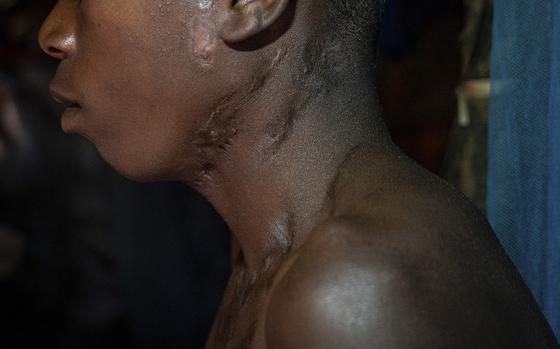R.A. shows the scars around his neck and chest left by his Islamic State captors in a village near Pemba, Mozambique, on Sept. 2. MUST CREDIT: Washington Post photo by Salwan Georges.