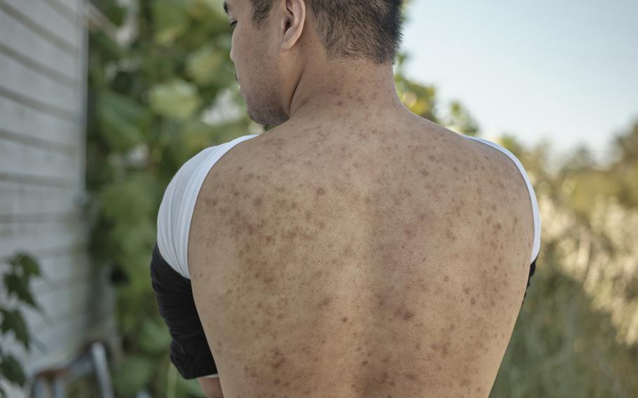 Andy Tai Huynh says he was ravaged by bedbugs while in captivity and still bears the scars after his release. MUST CREDIT: Photo for The Washington Post by William DeShazer.