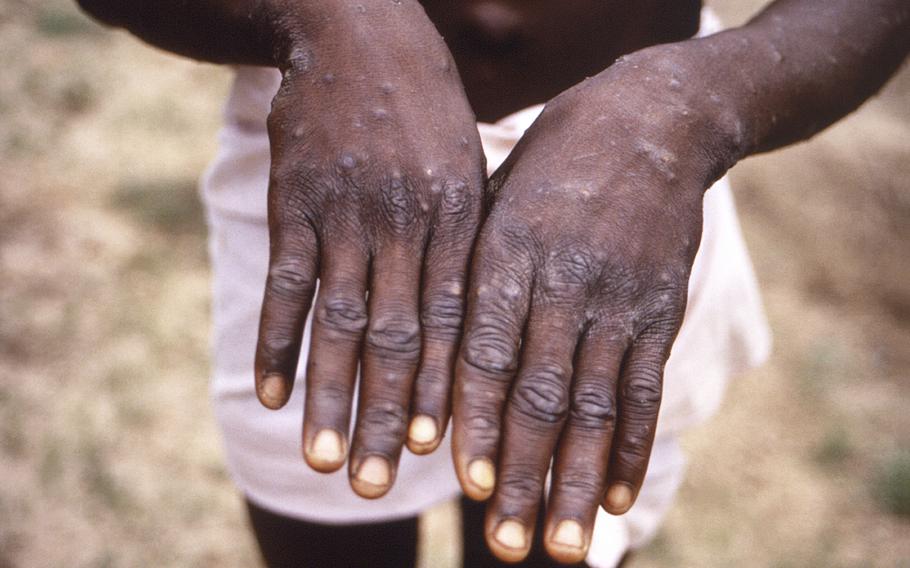 This 1997 image provided by the CDC shows the surfaces of the hands of a monkeypox case patient and the characteristic rash during its recuperative stage. The first case of monkeypox has been confirmed within the Naval Support Activity Naples community, officials announced Thursday, July 21, 2022. 