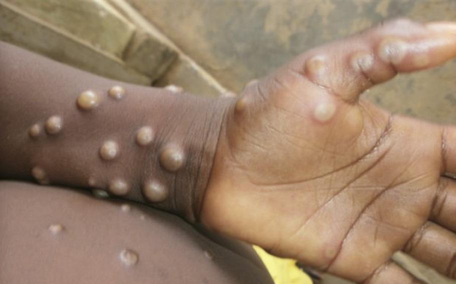 Since early May 2022, about 900 confirmed cases of monkeypox have been reported across 21 European countries.
