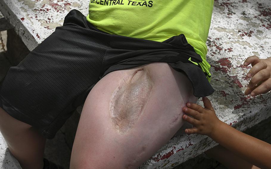 Ryland Ward shows a gunshot wound on his leg. After the shooting, doctors said Ryland had lost 80% of his blood. His heart stopped beating twice on the operating table. He spent weeks in a coma.