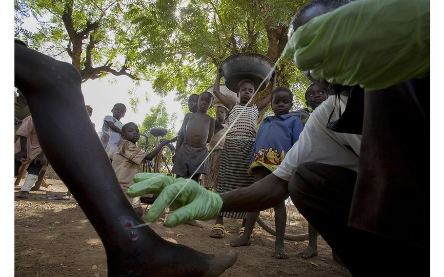 A medical worker extracts a Guinea worm from a child’s leg in northern Ghana in 2007. 