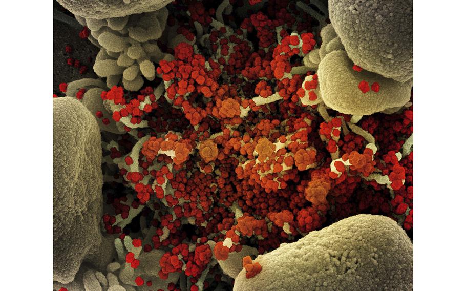 Colorized scanning electron micrograph of a cell heavily infected with SARS-CoV-2 virus particles (orange/red), isolated from a patient sample. 