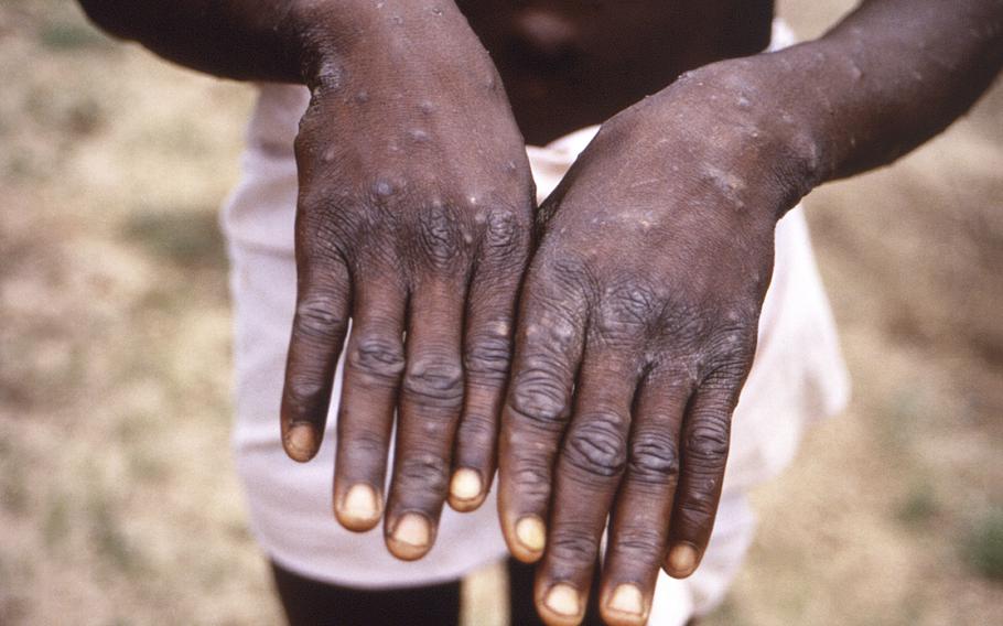 This 1997 image provided by the CDC  during an investigation into an outbreak of monkeypox, which took place in the Democratic Republic of the Congo (DRC), formerly Zaire, and depicts the dorsal surfaces of the hands of a monkeypox case patient, who was displaying the appearance of the characteristic rash during its recuperative stage. 