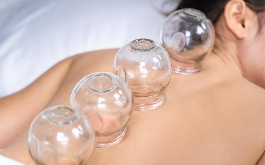 Cupping has grown in popularity in recent years, though evidence of its benefits is scarce.