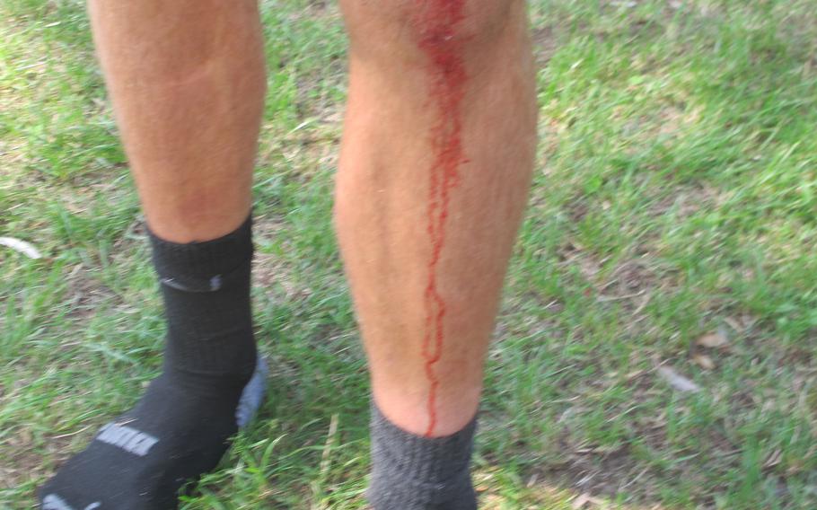 Andrew McGovern came in second in his first cross country race. He might have been even faster but for the spill on a turn that bloodied his knee.
