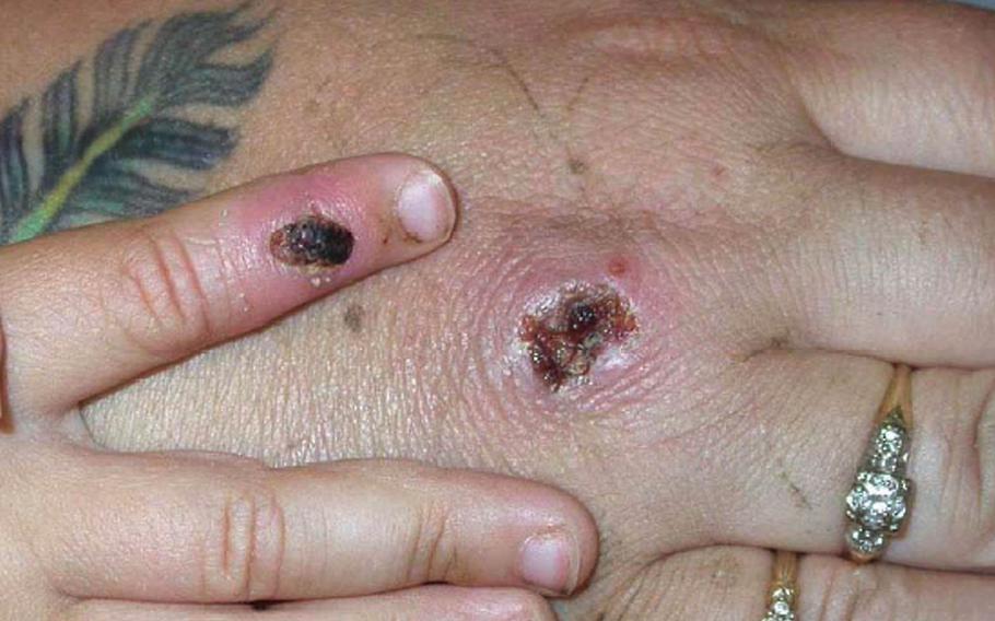 In this Centers for Disease Control and Prevention handout graphic, symptoms of one of the first known cases of the monkeypox virus are shown on a patient's hand on June 5, 2003. 