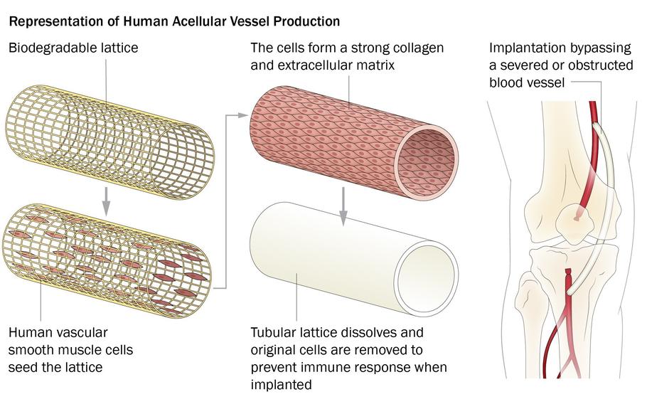 Development of the Human Acellular Vessel, or HAV, starts by taking living cells from a human blood vessel and placing them onto a tube-shaped frame. These vascular cells are kept alive in an organ chamber, growing around the tube-shaped lattice. Over time, the lattice that was used to seed the original vascular cells dissolves, and scientists remove the original cells so the new vessel doesn’t cause an immune response when it’s implanted. What is left is a solid, tubular structure made of human vascular material that looks and acts like a blood vessel — thus, the bio-engineered and newly-grown blood vessel, or HAV.  