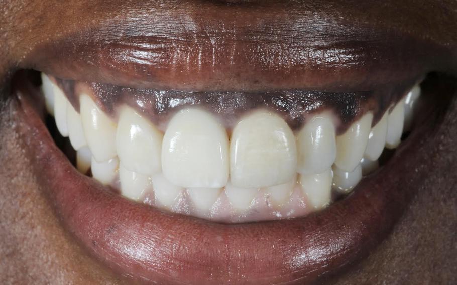 A dental patient smiles.