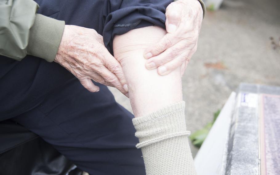 A WWII veteran shows a bullet wound on his leg.