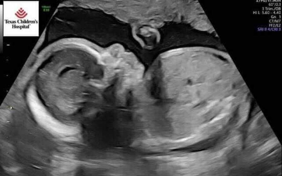 Chris and Diana Crouch's baby Cameron, in utero, at about 23 weeks. 