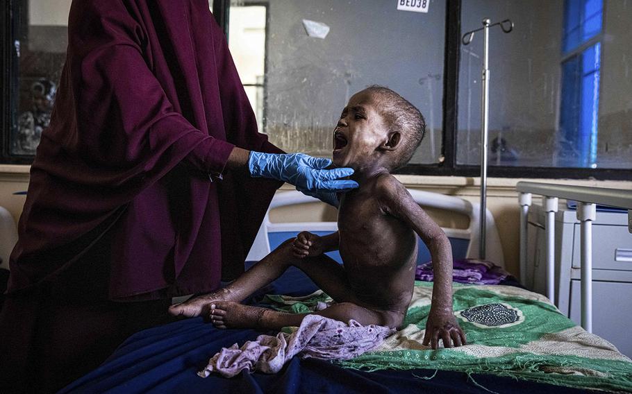 Ali Abdullahi Mohamed, a severely malnourished 27-month-old boy, is examined by a nurse for treatment in Banadir Maternity and Children Hospital in Mogadishu, Somalia, on June 1, 2022. Four consecutive seasons of poor rains have left millions of drought-stricken people in Kenya, Somalia and Ethiopia facing starvation. 
