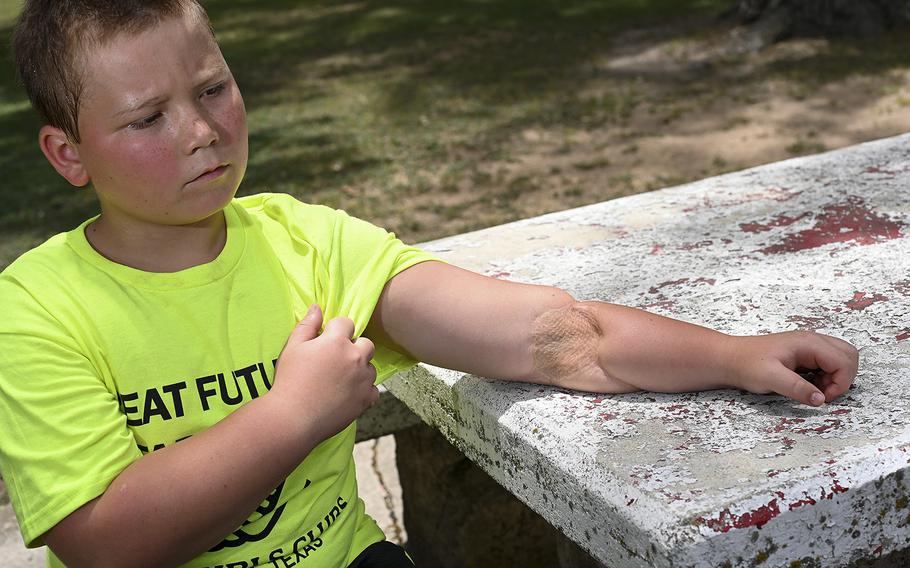 Ryland Ward shows a gunshot wound on his left arm on June 8, 2022. Ward was 5-years-old when he was shot multiple times after a gunman entered First Baptist Church in Sutherland Springs, Texas, killing 26 people with an AR-15 style weapon in 2017. 