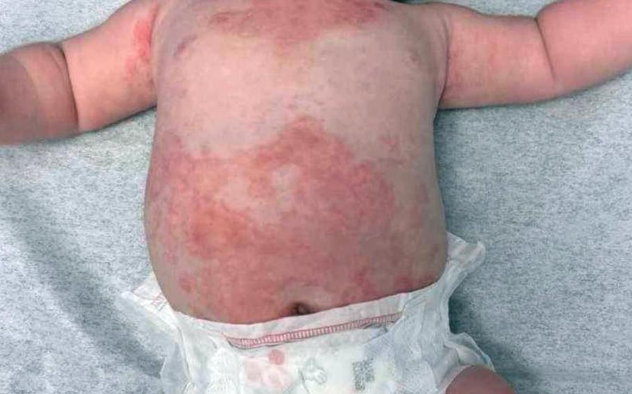 The Community Representative Initiative received this photo last week of an infant’s rash from a family that believes the condition was due to contaminated water in the their home that uses the Navy’s water supply near Pearl Harbor, Hawaii.
