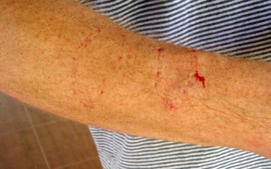 Blood and two sets of teeth marks are visible on the arm of Stars and Stripes reporter Jon Rabiroff after his encounter with an angry monkey in the Monkey Forest in Ubud on the Indonesian island of Bali.