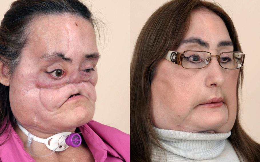 The before-and-after photo shows Connie Culp's transformation as the recipient of the first U.S. face transplant in 2008 at The Cleveland Clinic. Culp lost her left eye, nose, lower eyelids, roof of her mouth and upper lip after being shot in the face in 2004. She could not eat or taste food, drink from a cup or smell again until after the face transplant.