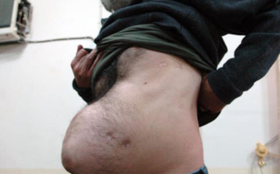 Iraqi Media Network station manager Nasser Hassan shows off his abdomen, which absorbed 35 slugs from an AK-47 in an attack near Mosul last year. The attack killed one station employee and wounded another.