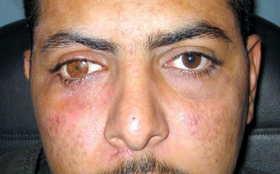 This Iraqi man received a prosthetic eye made by Dr. Arthur W. Bryant out of ceramics and paint. Normally, he would be able to meet with patients several times to match eye color and size, but he saw the Iraqi patients only once or twice.