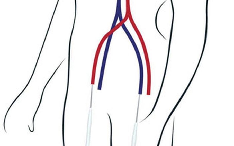 The Novalung ILA aids the lungs by drawing off carbon dioxide from the blood and infusing cells with oxygen. Inserted by catheters into the major arteries in the thighs, it relies on the patient’s heartbeat to pump blood out of one leg, across the special membrane that performs the transfer and back into the body through the other leg.