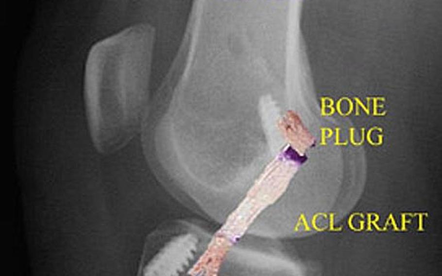 A post-operation image shows a tendon graft used to repair a torn anterior cruciate ligament.