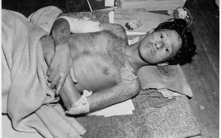 A survivor of the atomic bombing of Nagasaki, Japan, photographed after the attack Aug. 9, 1945.
