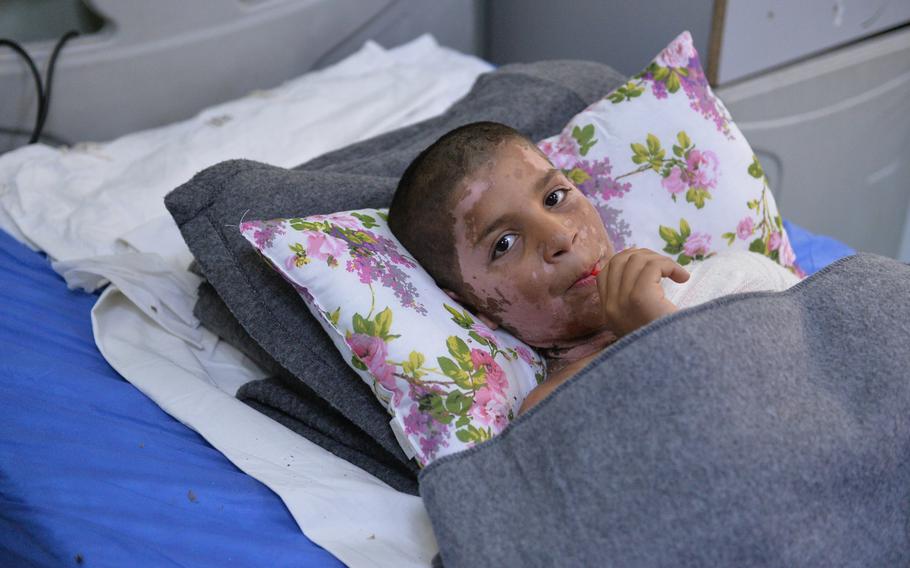Yasiv, 11, wounded in an apparent chemical attack in east Mosul in early March, recuperates in a hospital bed at an emergency hospital in Irbil, the capital of Iraq's autonomous Kurdish region, on Saturday, March 11, 2017. 


