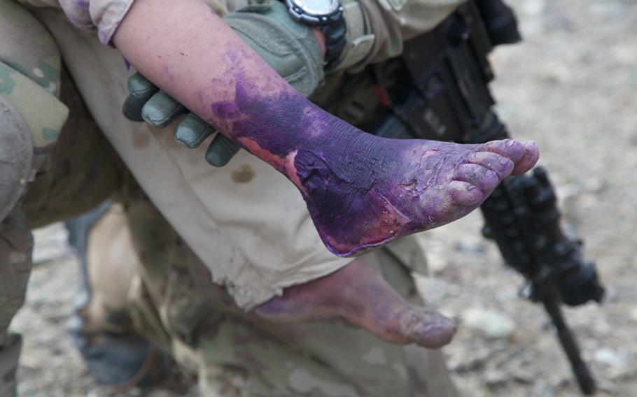 U.S. soldiers treat a young Afghan boy with first- and second-degree burns to his feet after he limped toward them for help. Injuries such as burns and broken fingers are often treated by Afghan doctors with little more than colored dye in this part of Khost province, despite the fact there is a government hospital less than 10 miles away.