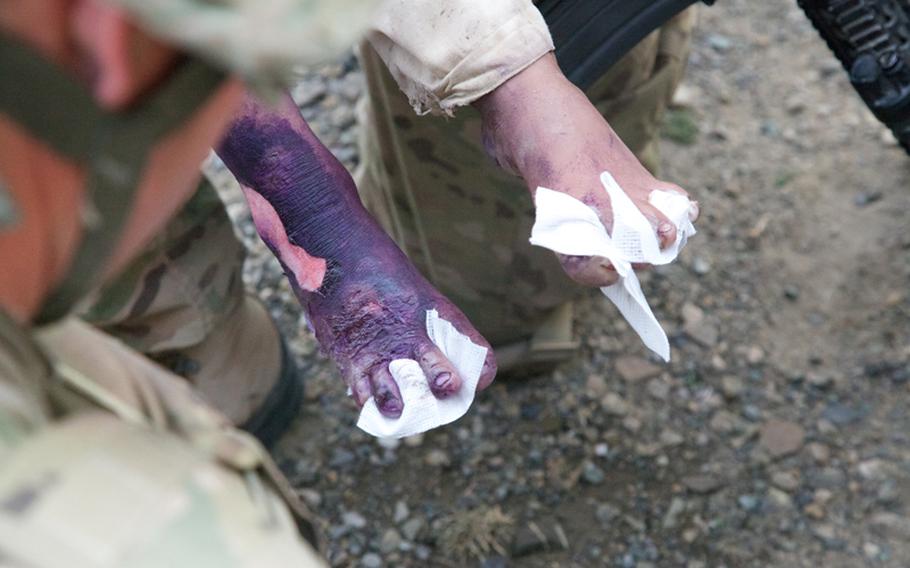 Gauze separates the toes of a young burn victim in order to keep the toes from welding together as they heal.