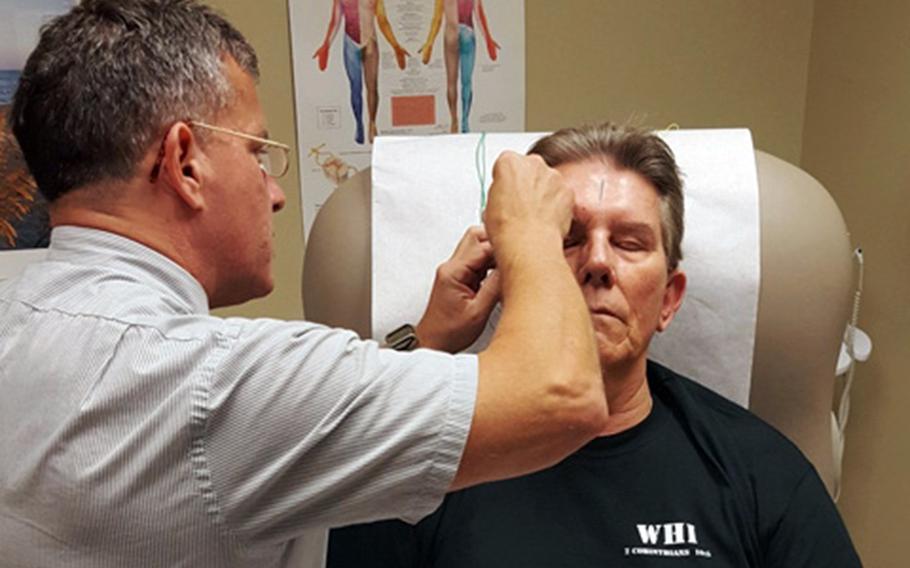 Navy veteran Peter Johnson receives acupuncture at the VA Greenville Health Care Center, N.C., in November 2016 to help relieve chronic headaches caused by massive head and eye injuries he suffered during the Vietnam War.