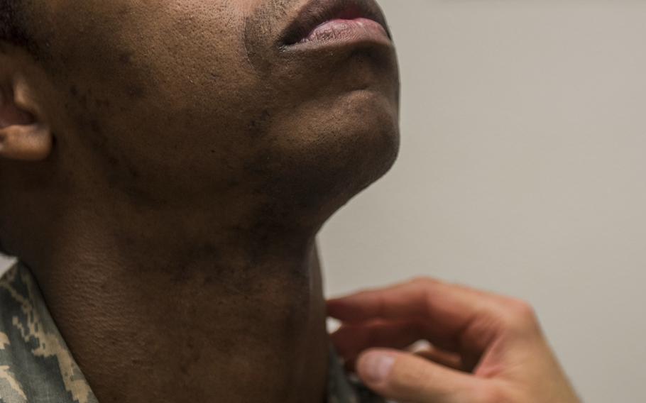 An airman raises his head as he has his neck and face inspected during a shaving waiver course at Beale Air Force Base, Calif., in March 2018. The Air Force surgeon general has authorized a five-year shaving waiver for airmen and Space Force personnel who have been diagnosed with razor bumps.