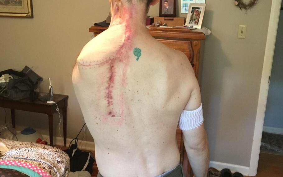 Former Air Force Maj. Brian Liebenow shows the scar that runs down his back since he had surgery in September 2016 to amputate his left arm, part of his clavicle and three ribs. The surgery was needed after a wound failed to heal after Liebenow had skin cancer. 

