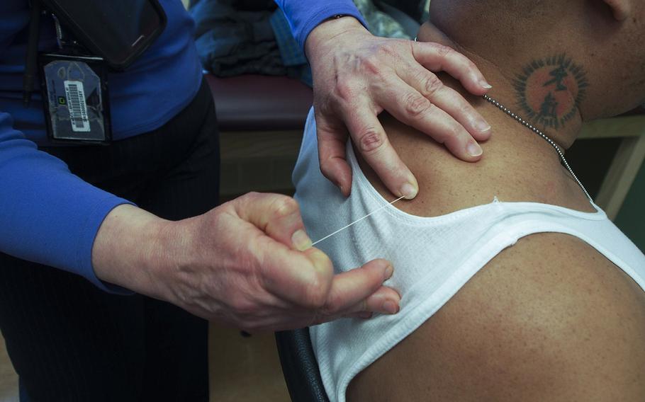 Dr. Heidi Klingbeil, chief of physical medicine and rehabilitation at the Bronx VA Medical Center, pulls an acupuncture needle out of a patient. Klingbeil has spearheaded a holistic approach to pain management that has greatly reduce the amount of opiates prescribed at the Bronx VA, as other VA hospitals face a crisis in opiate abuse.